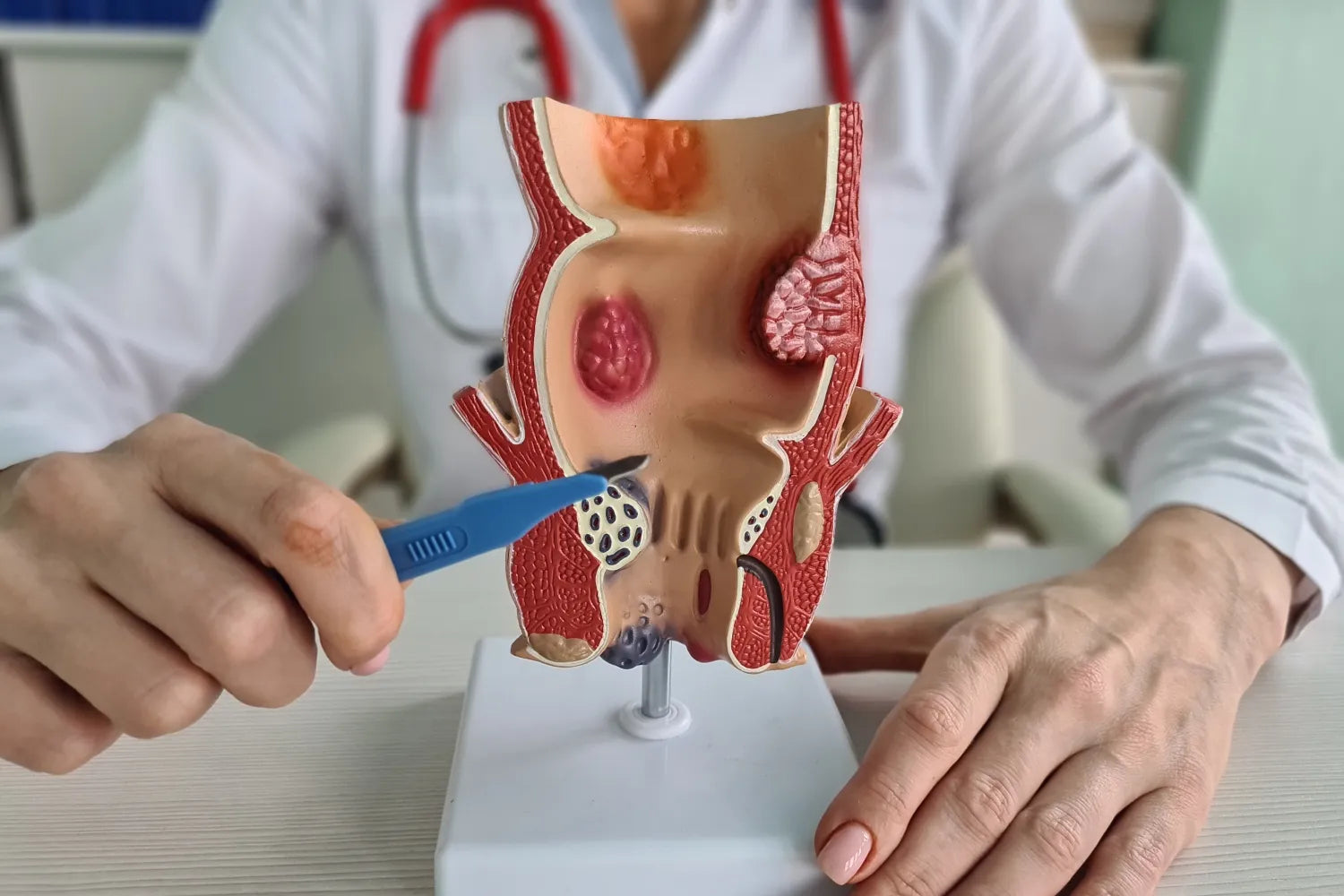 What Do Hemorrhoids Feel Like? Recognizing Symptoms and When To Seek Help