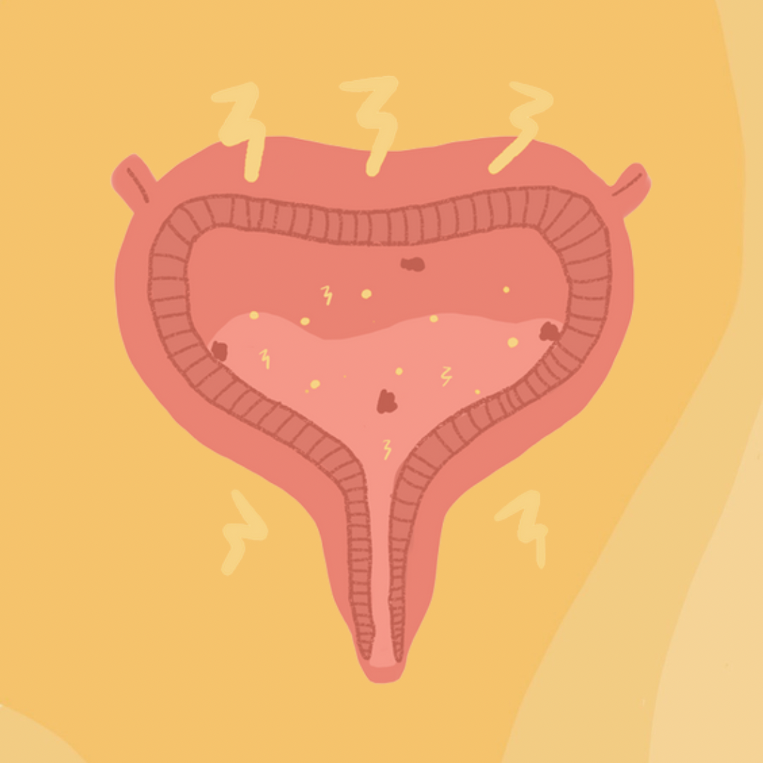 Chronic UTIs — The Secret Your Doctor Might Not Know to Tell You